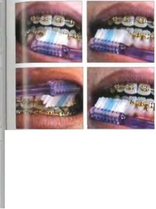 Расположение мануальной зубной щетки и введения суперфл» сов у диц с брекет-системами (к главе 2.6)