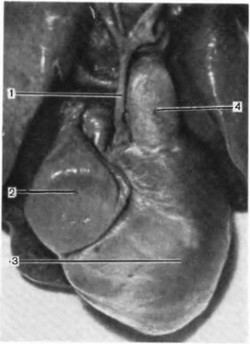Рис. 35. Синдром гипоплазии левого сердца. Атрезия аортального клапана с гипоплазией восходящей аорты.