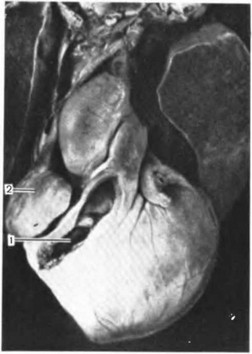 Рис. 36. Синдром гипоплазии правых отделов сердца. Недоразвитие правого желудочка (1) с гипоплазией трехстворчатого клапана и устья легочной артерии. Правое предсердие увеличено 