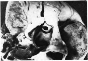 Рис. 39.t Клапанный стеноз легочной артерии. Диафрагма с центрально расположенным отверстием выбухает в ствол легочной артерии.