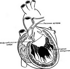 Рис. 53. «Сердце Холмса». Единый желудочек с нормальным соотношением крупных артерий и стенозом легочной артерии (клапанным и подклапанным). Легочная артерия отходит от инфундибулярной камеры.