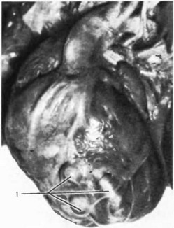 Рис. 56. Левая коронарная артерия, сообщающаяся с левым желудочком.