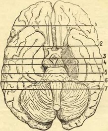 Рис. 36 Вскрытие головного мозга по Фишеру
