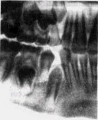 Рис. 13. Преждевременное прорезывание  вследствие удаления IV I по поводу хронического периодонтита (рентгенограмма).