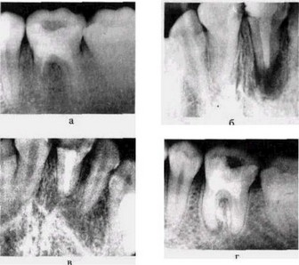 Рис. 20 Рентгенограмма зубов с хроническим периодонтитом до и после лечения