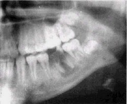 Рис 32 Хронический гранулирующий периодонтит Гб Остит нижней челюсти (рентгенограмма)