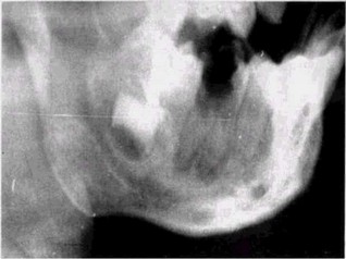 Рис. 34. Хронический гранулирующий периодонтит 1sl Остит нижней челюсти (рентгенограмма)