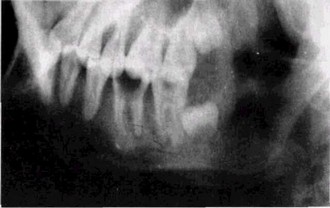 Рис 35 Хронический гранулирующий периодонтит  Остит нижней челюсти (рентгенограмма)