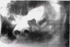 Рис. 44. Остеомиелит в период ремиссии у пациента 8 лет (боковая рентгенограмма ниженей челюсти)