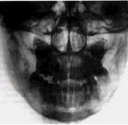 Рис 49 Хронический гиперпластический остеомиелит (рентгенограмма) Гибель зачатка) Массивные периостальные напластования и размытость костного рисунка в области ветви