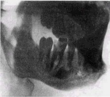 Рис 52. Хронический периодонтит ~6\ гиперпластический остеомиелит (рентгенограмма). Утолщение челюсти. Процессы резорбции и восстановления уравновешены.