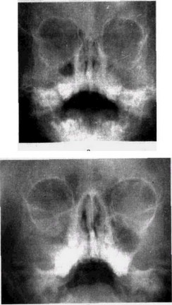 Рис. 56. Хронический гайморит. Обзорная рентгенограмма верхнечелюстной пазухи