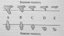 Рис. 10 Классификация степеней атрофии беззубых
			челюстей по Lekholm amp; Zarb (1985 г.)