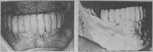Рис. 18 Посмертная фотография полости рта пациента и препарат нижней челюсти пациента с несъёмным зубным протезом, опирающимся на имплантаты.