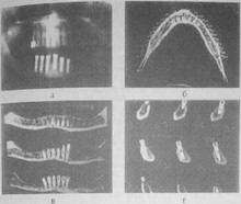 Рис. 24 Установлено 6 имплантатов в беззубую нижнюю челюсть в межментальной области с межкортикальной фиксацией