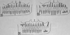 Рис. 25 Схема использования различных типов имплантатов при одиночных (А), включенных (Б) и концевых (В) дефектах зубных рядов