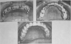 Рис. 28 Установка 8 двухэтапных винтовых имплантатов при полной адентии верхней челюсти для восстановления зубного ряда по вторые моляры