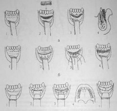 Рис. 38 Метода вестибулопластики: а — Простейший способ углубления преддверия полости рта