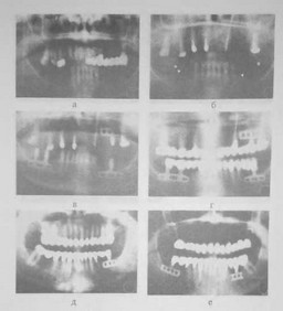 Рис. 46 Имплантация и протезирование при концевых и включенных дефектах зубного ряда
