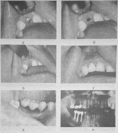 Рис. 48 Протезирование на имплантатах при отсутствии одного или нескольких зубов