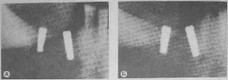 Рис. 63 Рентгенологическая картина до и после лечения переимплантита