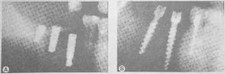 Рис. 64 Рентгенологическая картина отторжения имплантатов