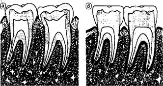 Рис. 9-8. Стирание апроксимальных (контактирующих) поверхностей зубов и возрастные изменения периодонта.