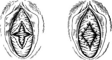 Рис 72. Рассечение девственной плевы при заращении 1 — крестообразные разрезы; 2 — на края разрезов наложены швы