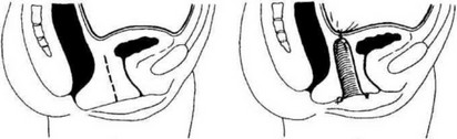 Рис. 74. Кольпопоэз с помощью брюшины малого таза: 1 — пунктирная линия соответствует искусственному ложу влагалища; 2 — влагалище из брюшины сформировано.