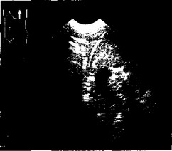 Рис. 4.4. Продольное сканирование слева по средней подмышечной линии. Фрагмент подциафрагмального абсцесса слева.