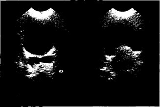 Рис. 4.8. Поперечное сканирование. Слева — скопление выпота в полости малого таза; справа — деформация образования при пальцевом исследовании.