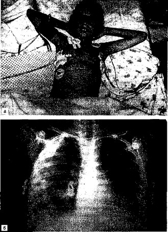 Рис. 7.9. Больная К., 9 лет. Двусторонняя деструктивная пневмония, пиопневмоторакс слева.