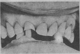 Рис. 8. Вторичная деформация зубных рядов при патологической стираемости, развившейся вследствие функциональной перегрузки оставшихся трех пар антагонирующих зубов.