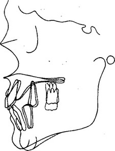 Рис. 20. Схематичное изображение изменений в лицевом скелете у больных первой группы преимущественно с зубоальвеоляриым удлинением на верхней челюсти.