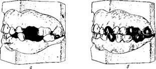 Рис. 22. Устранение окклюзионных нарушений, сопровождающихся блокадой движений нижней челюсти путем укорочения зубов.