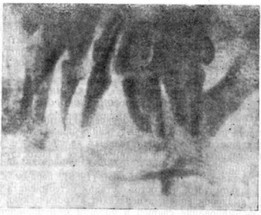 Рис. 5. Рентгенологическая картина хронического диффузного деструктивного одонтогенного остеомиелита нижней челюсти.