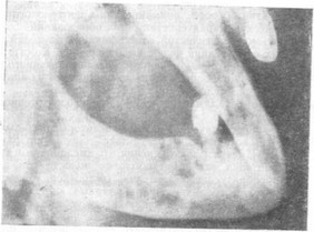Рис. 13. Рентгенологическая картина мелкоячеистого типа амелобластомы (адамантиномы) нижней челюсти.