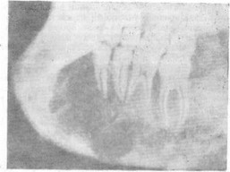Рис. 14. Рентгенологическая картина ячеистой формы остеобластокластомы нижней челюсти.