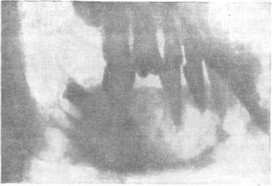 Рис. 16. Рентгенологическая картина внутрикостной гемангиомы нижней челюсти.