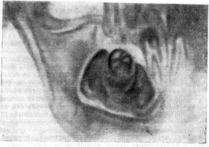 Рис. 17. Рентгенологическая картина твердой сложной одонтомы нижней челюсти.