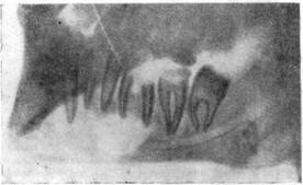 Рис. 18. Рентгенологическая картина околокорневой кисты нижней челюсти.