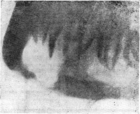 Рис. 19. Рентгенологическая картина эозинофильной гранулемы нижней челюсти.