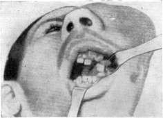 Рис. 22. Остеогенная саркома верхней челюсти (из работы И. И. Ермолаева, А. А. Колесова, М. П. Горбушиной).