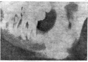 Рис. 23. Рентгенологическая картина остеогенной саркомы нижней челюсти.