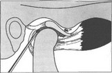 Рис. 6. Схема артрографии с введением контрастного препарата в нижний этаж полости височно-нижнечелюстного сустава.
