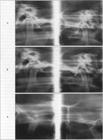 Рис. 24. Б-ая 3-в, 30 лет. а. Зонограмма височно-нижнечелюстных суставов в криволинейной окклюзии. Суставная головка слева смещена во впадине вниз и назад; б. Зонограмма той же больной с открытым ртом. 