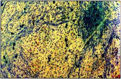 Фото 8 Увеличение численности тучных клеток III степени дегрануляции при одновременном снижении «нулевых» форм Брыжейка тонкой кишки крысы-самки при лечении традиционными методами на 10-е сутки после родов, окраска по Горчакову х 1000