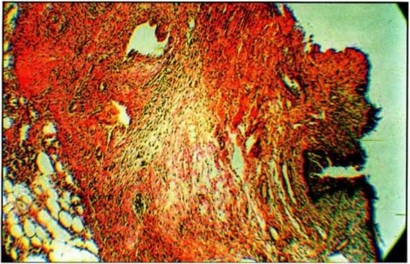 Фото 9 Раневой дефект с началом эпителизации и формированием рыхлой соединительной ткани Рана промежности крысы-самки при лечении медицинским озоном на 5-е сутки после родов, окраска по Ван Гизону. х 300