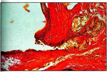 Фото 10 Грубоволокнистая соединительная ткань Рана промежности крысы-самки при лечении медицинским озоном на 10-е сутки после родов, окраска по Ван Гизону, х 300